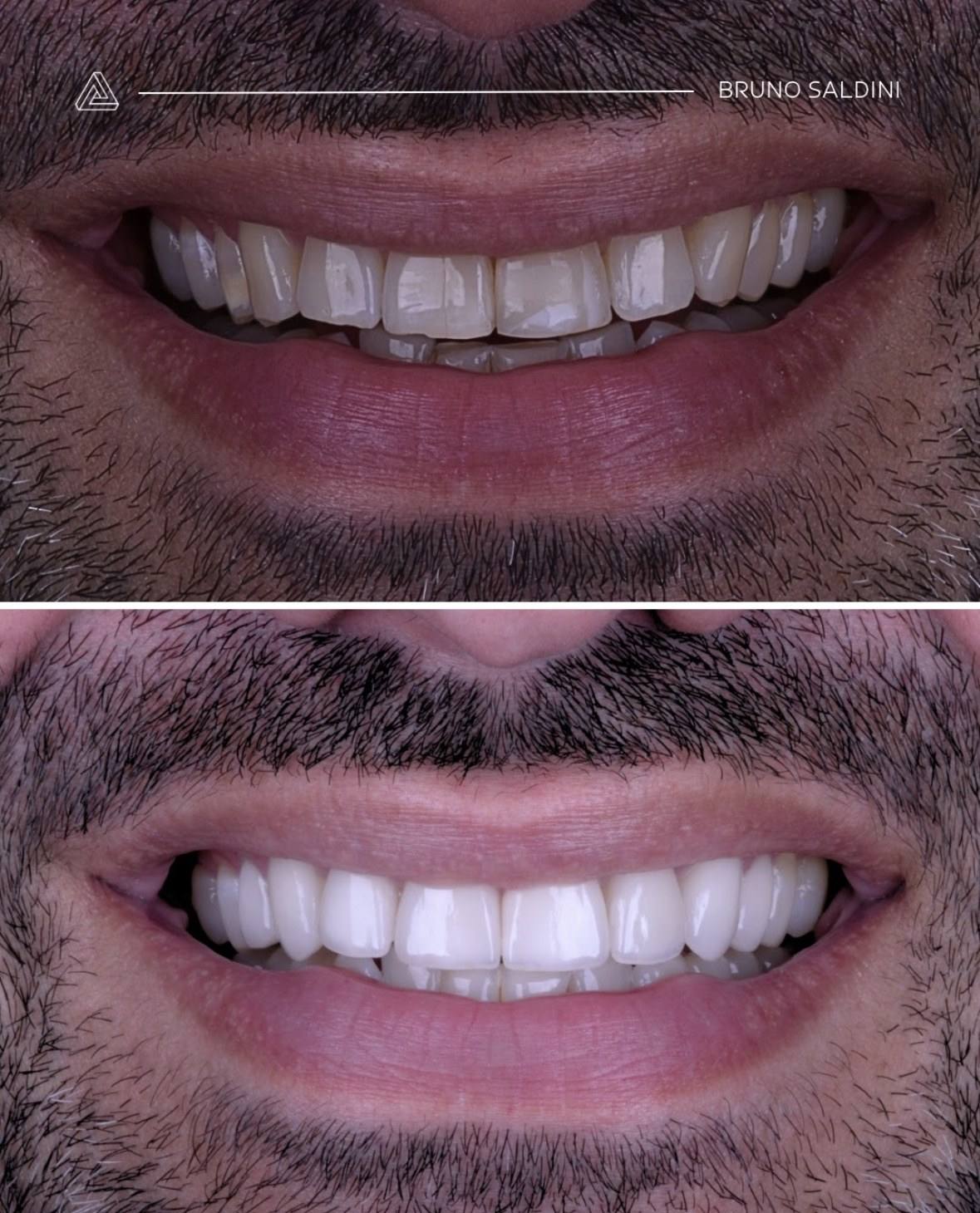 Antes: dentes curtos e desgastados. Depois: comprimento e forma recuperados.