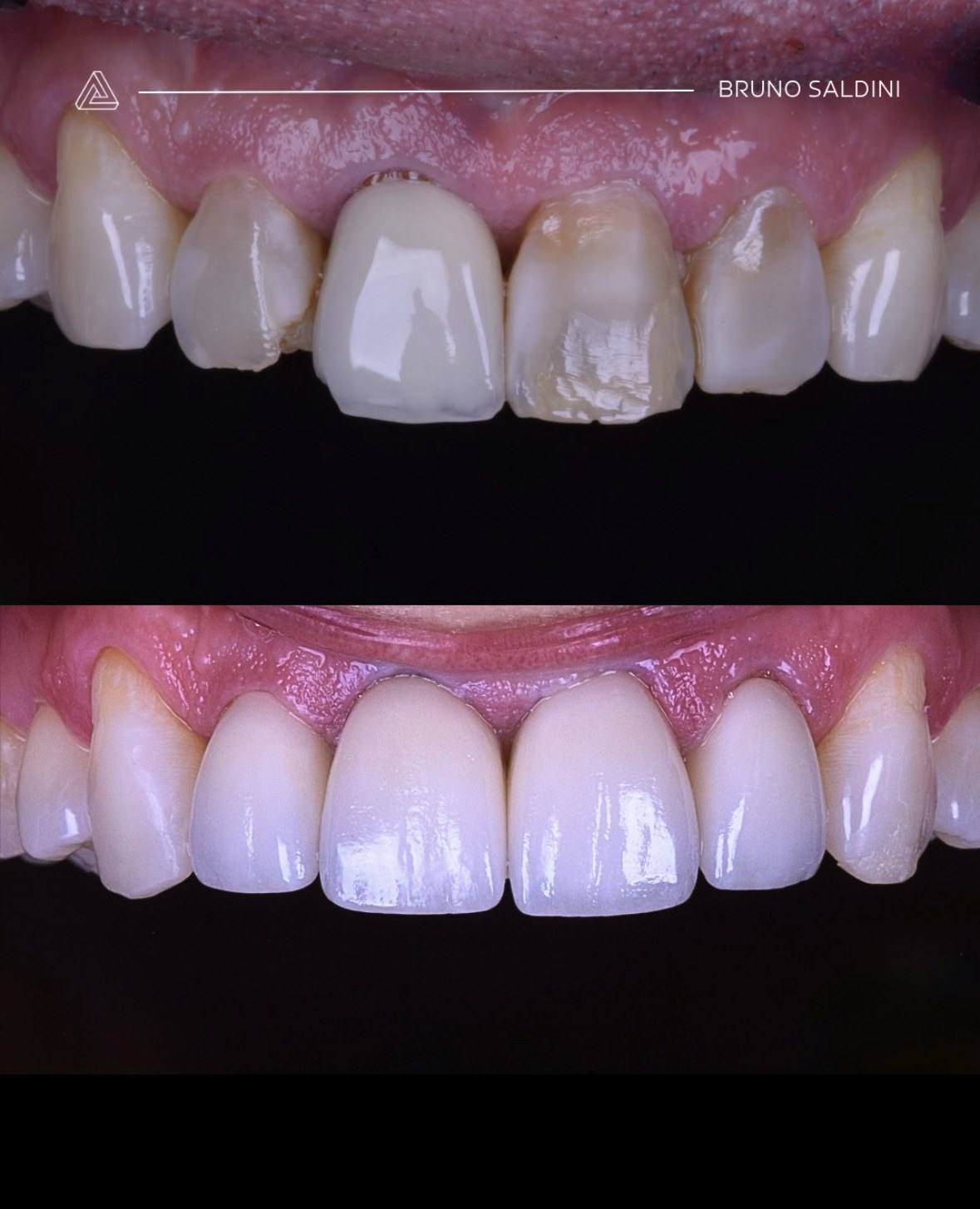 Antes: coroa antiga escurecida e dente fraturado. Depois: dentes anteriores uniformes em porcelana.