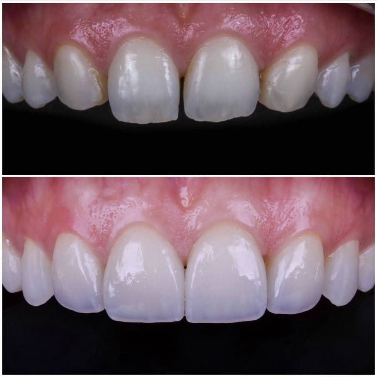 Antes: dentes anteriores com espaços e manchas. Depois: facetas em porcelana com forma e cor harmônicas.