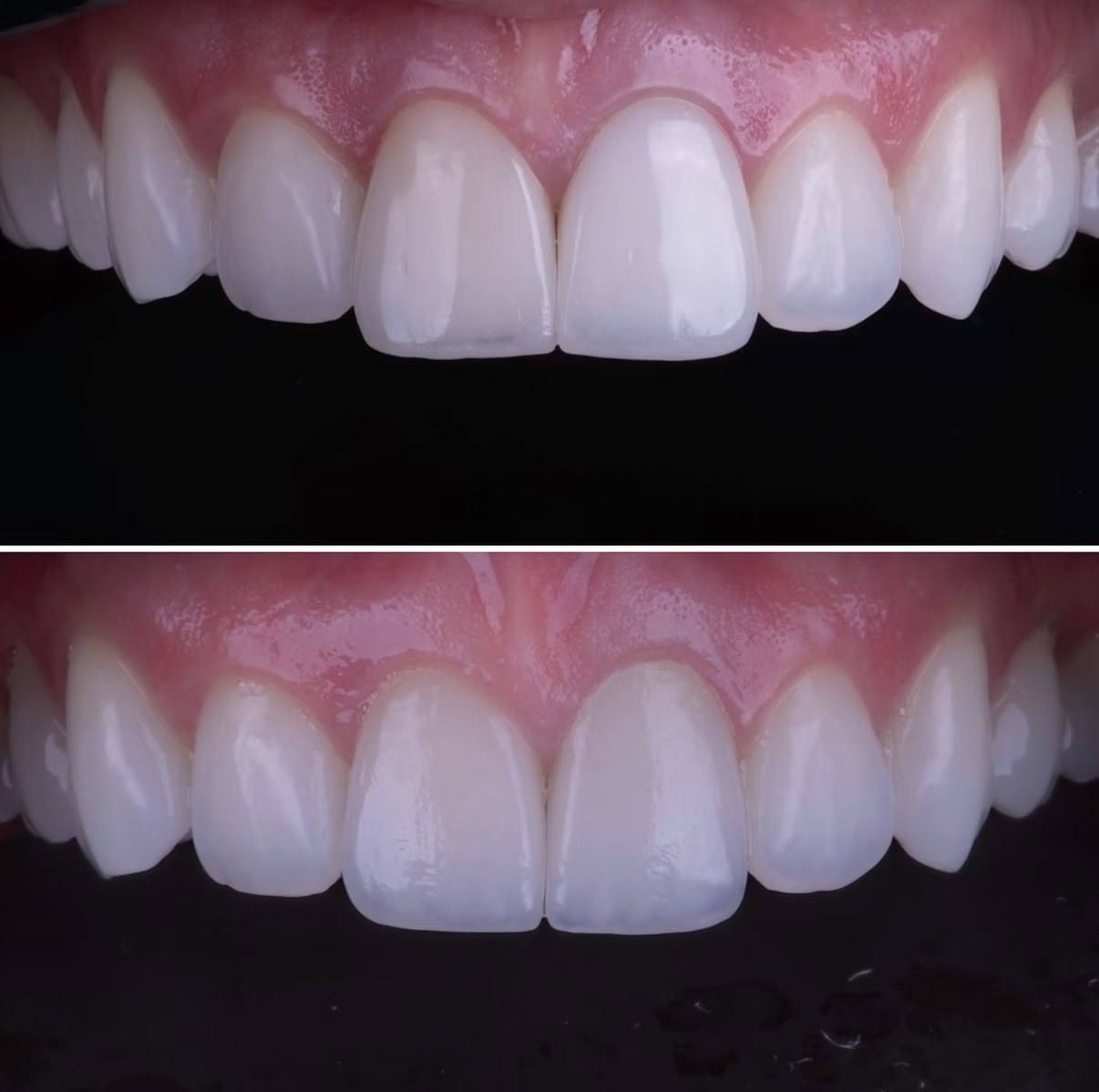 Antes e depois de refinamento estético dos dentes anteriores.