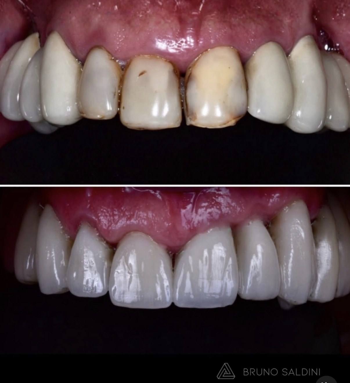 Antes: restaurações antigas escurecidas e desgastadas. Depois: reabilitação em porcelana com aparência natural.