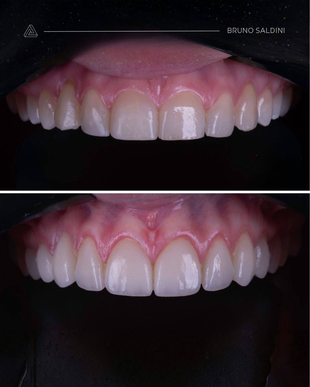 Antes e depois de dentes superiores desgastados pelo bruxismo.