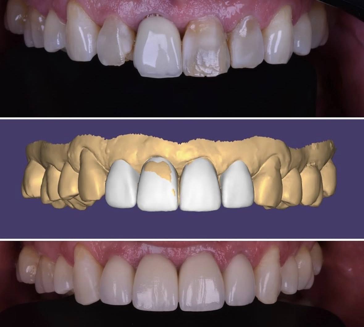 Antes, planejamento digital em computador e resultado final dos dentes anteriores.