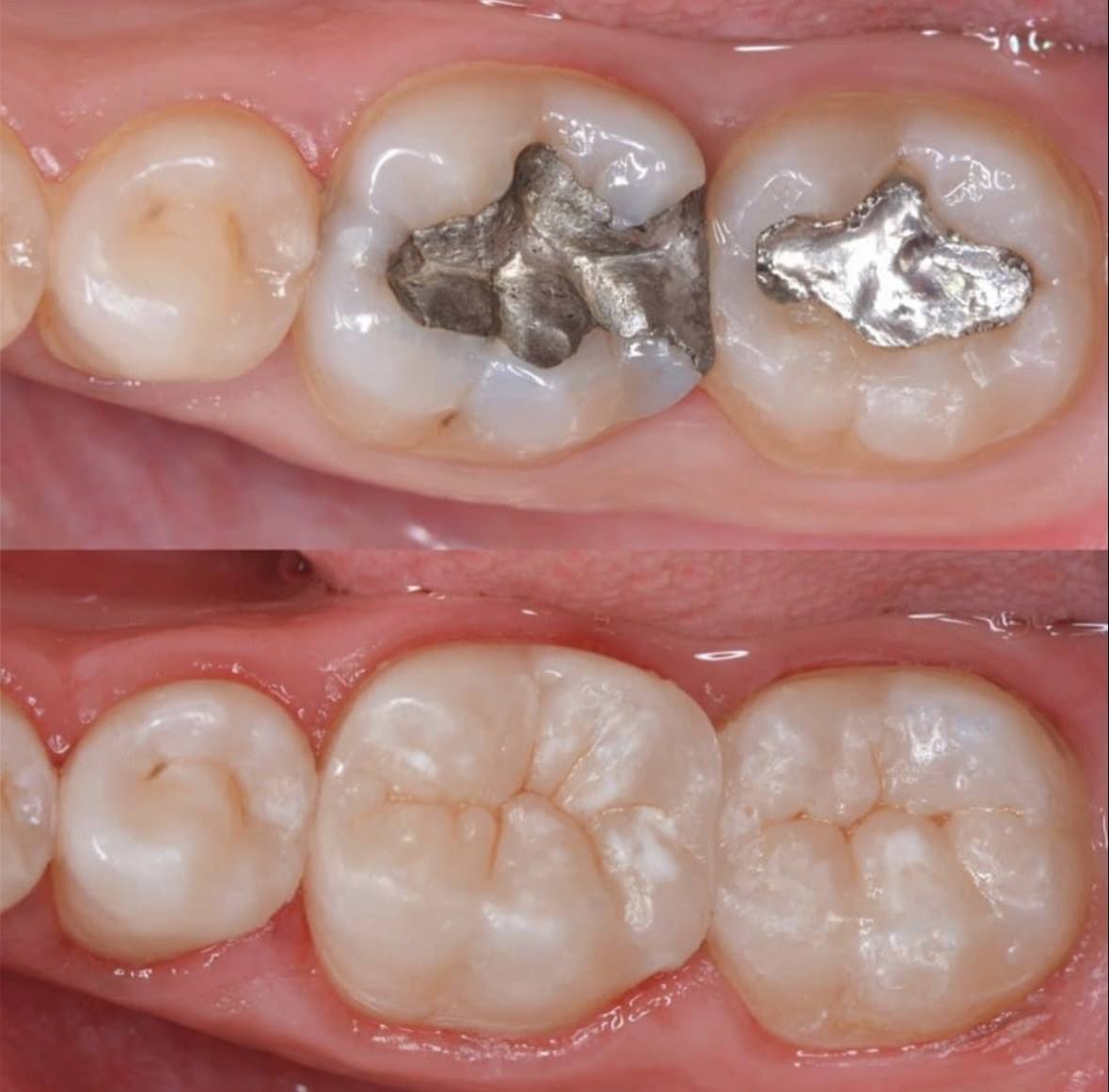 Molares antes, com restaurações metálicas de amálgama, e depois, com restaurações da cor do dente.