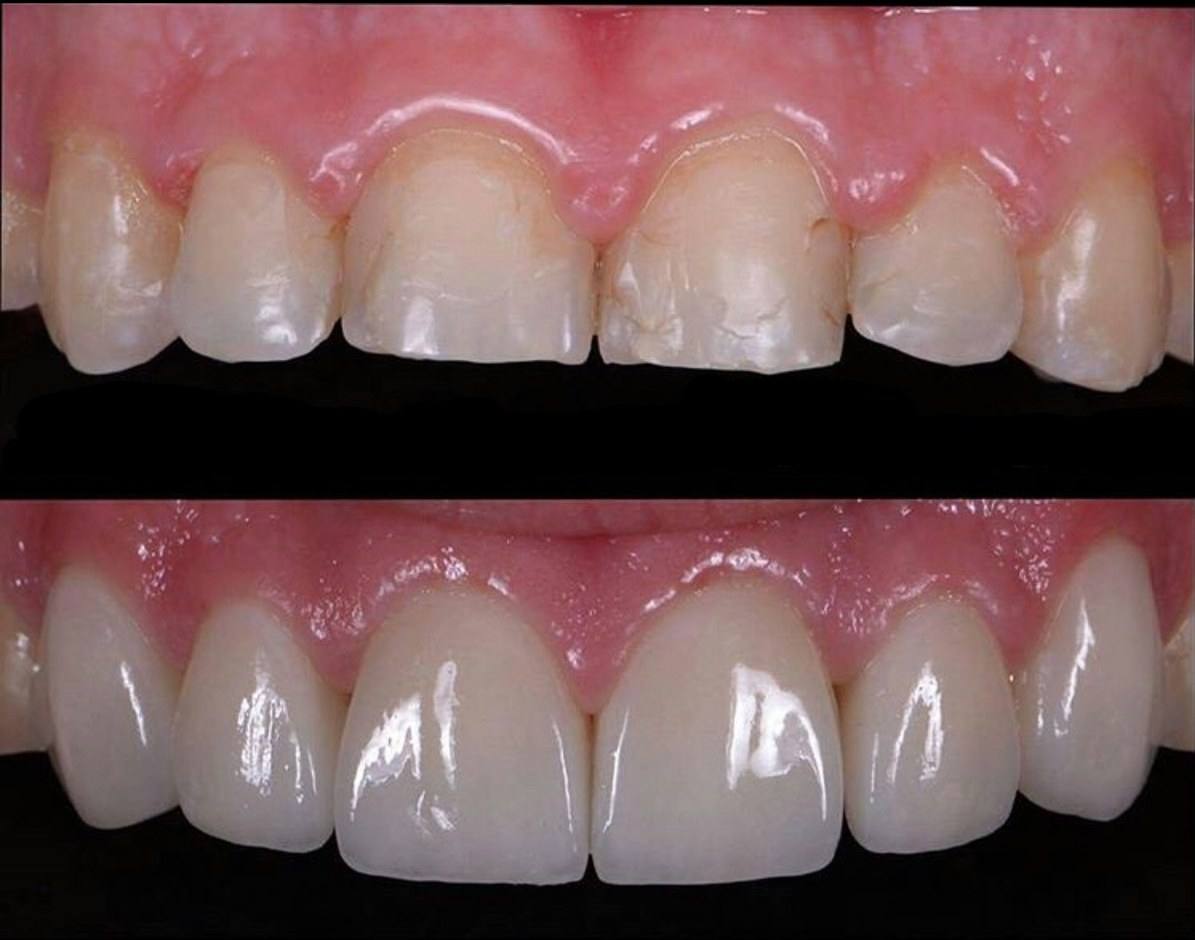 Antes: dentes anteriores desgastados, com bordas irregulares e trincas. Depois: forma e comprimento recuperados.