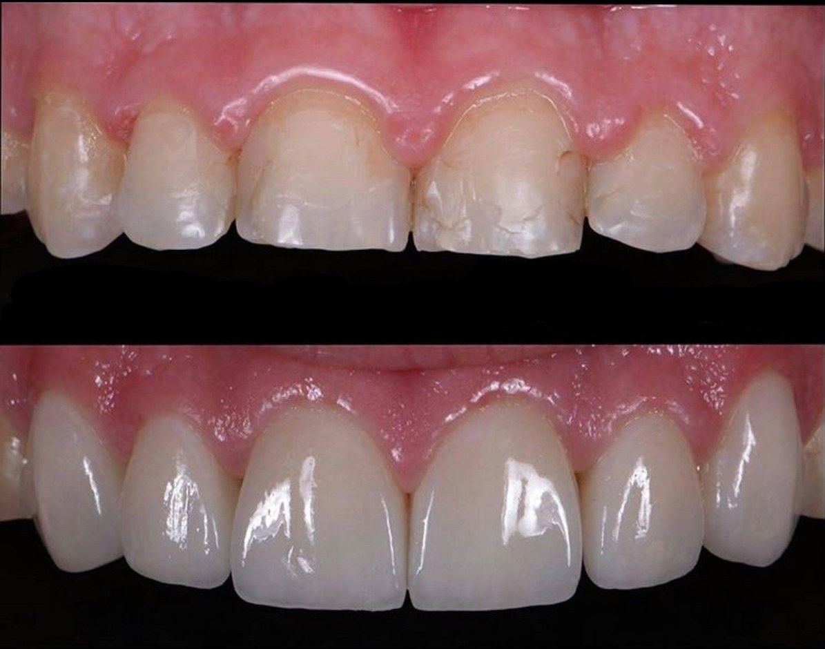Antes: dentes anteriores desgastados, com bordas irregulares e trincas. Depois: forma e comprimento recuperados.