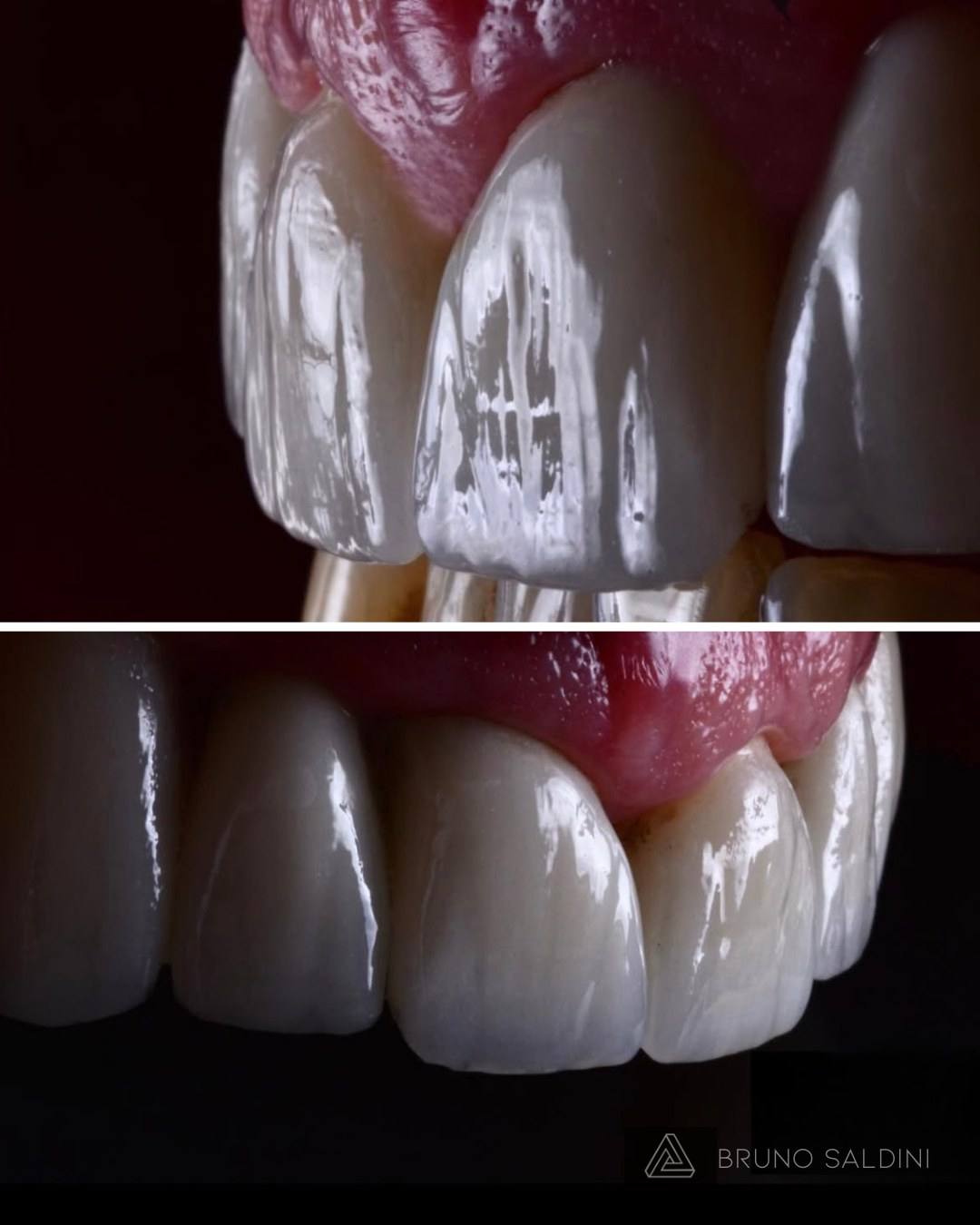 Detalhe aproximado de uma faceta em porcelana, mostrando textura e translucidez naturais.