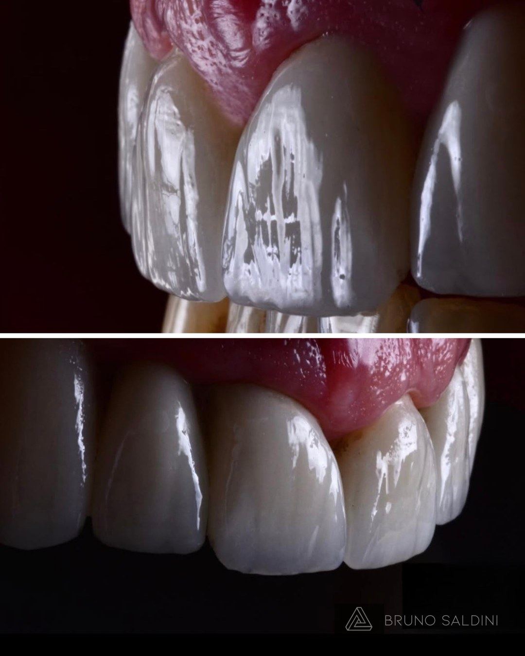 Detalhe aproximado de uma faceta em porcelana, mostrando textura e translucidez naturais.