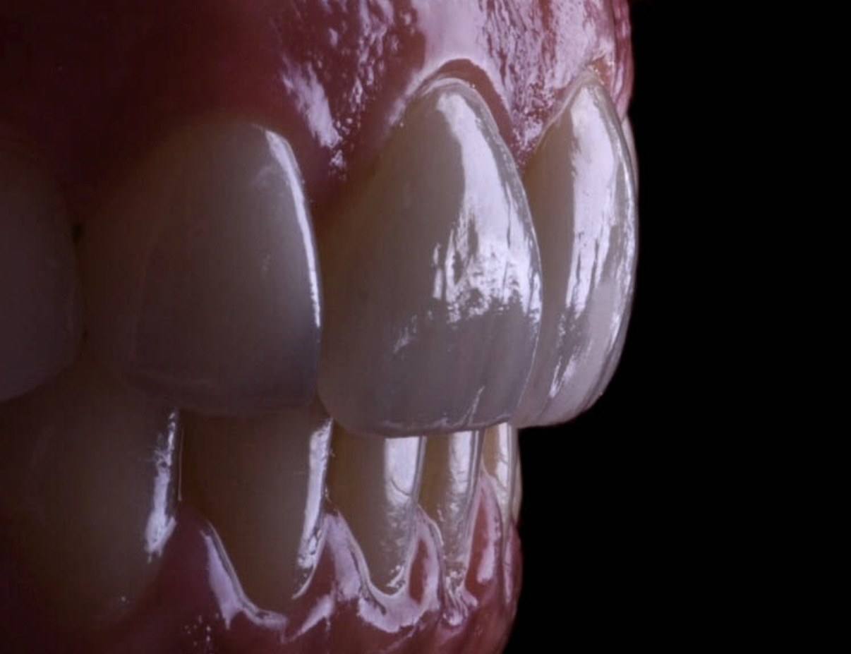 Detalhe aproximado de facetas em porcelana sobre fundo escuro.