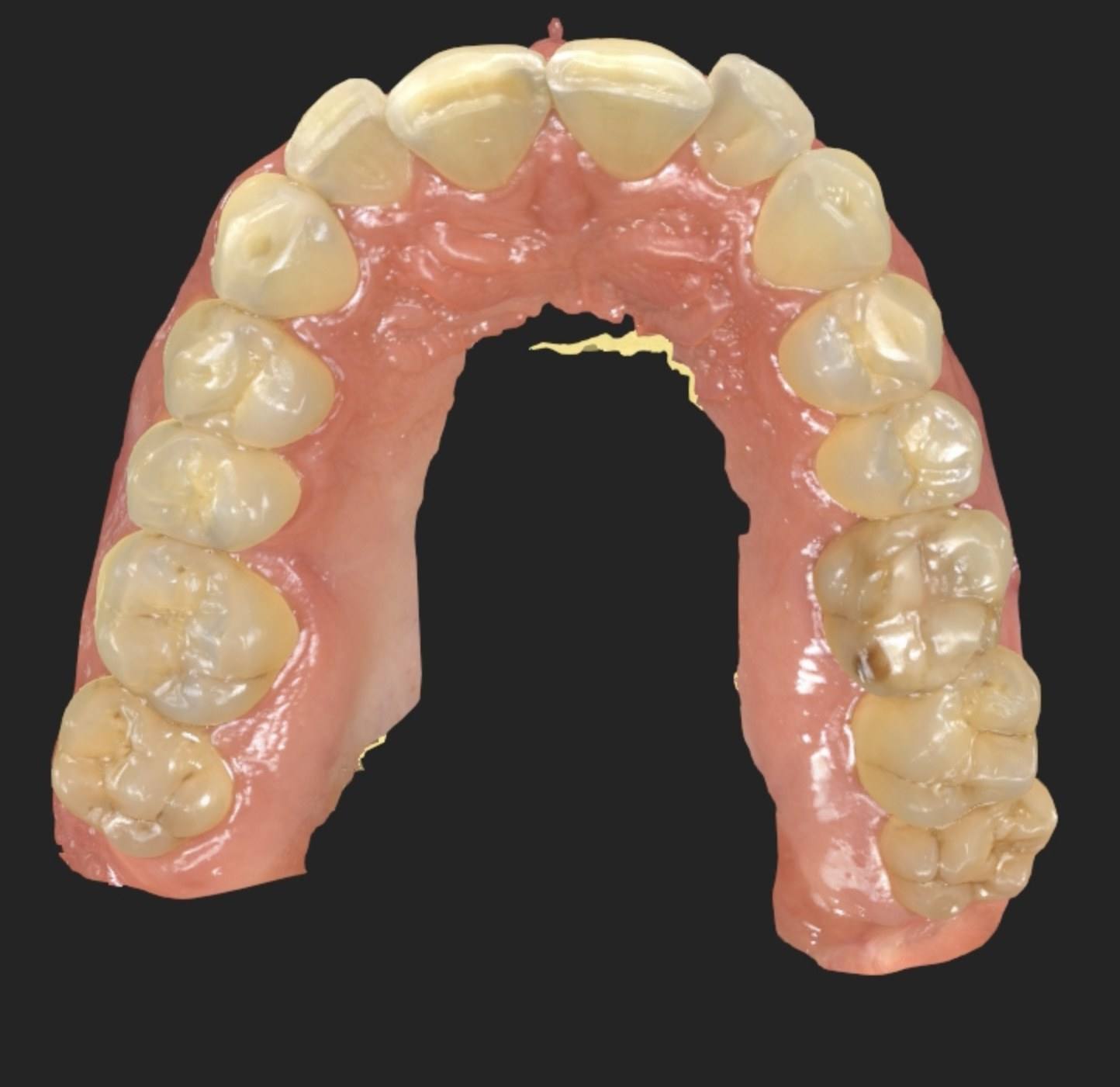 Escaneamento 3D da arcada superior vista de baixo (oclusal).